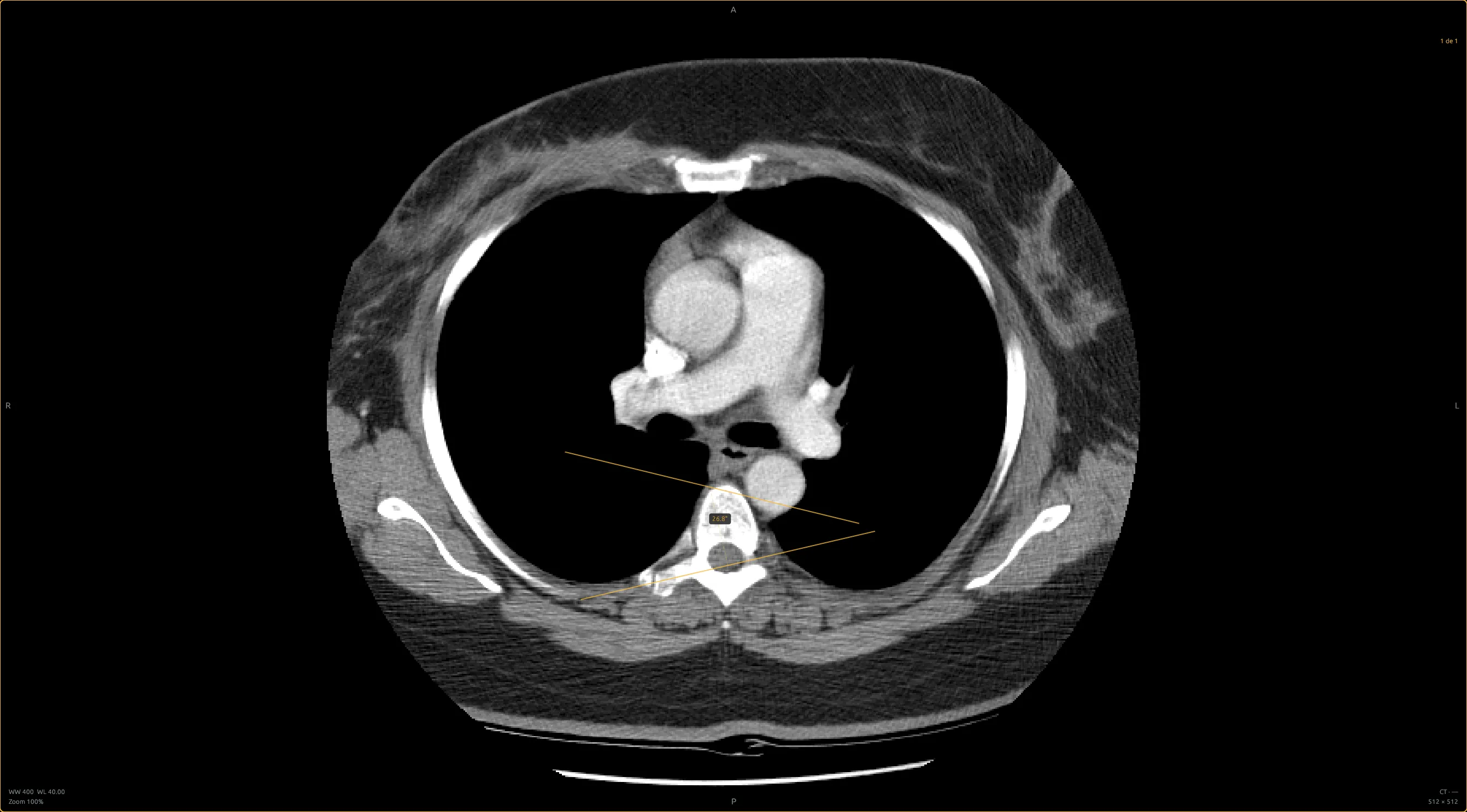 Akhet PACS with Cobb angle